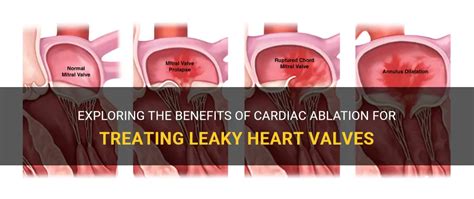 Exploring The Benefits Of Cardiac Ablation For Treating Leaky Heart