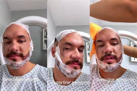 Eliezer Ex Bbb Mostra Resultado De Transplante Capilar E De Barba Veja Imagens