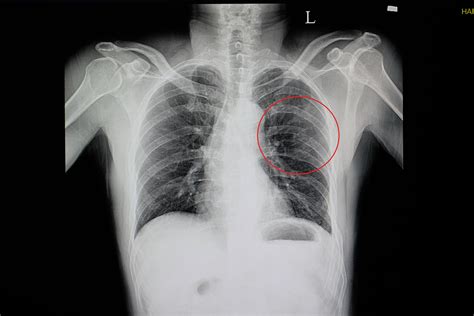 Rib Fractures Serious For Elderly Adults The Oldish