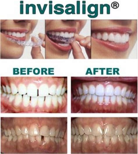 Change Your Smile Get Invisalign In Hollywood