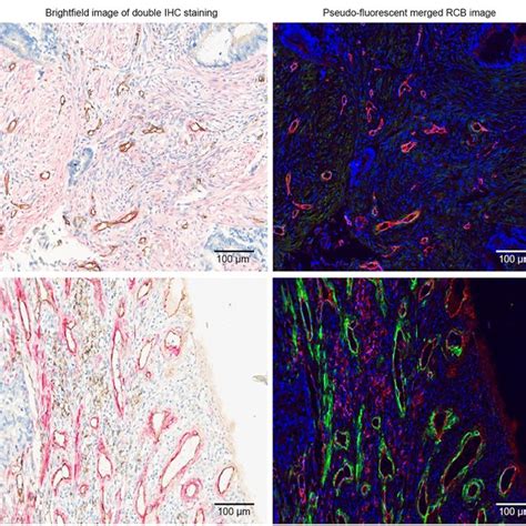 Double IHC staining and image analyses of mCRC tissue. Notes: Tissue 