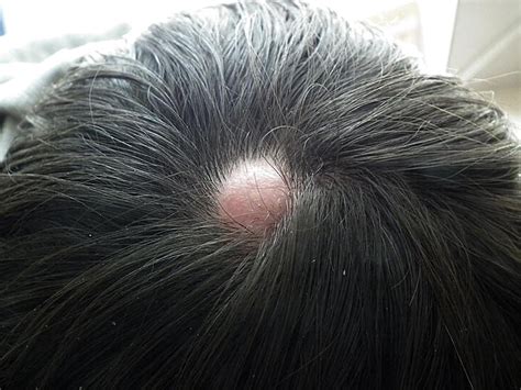 Alopecia Associated Pseudocyst Of The Scalp Journal Of The American
