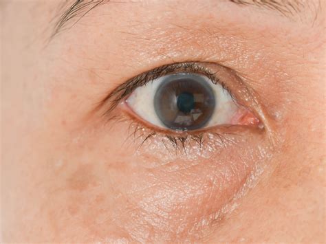 Under Eye Swelling Causes Shop Price Save 62 Jlcatjgobmx