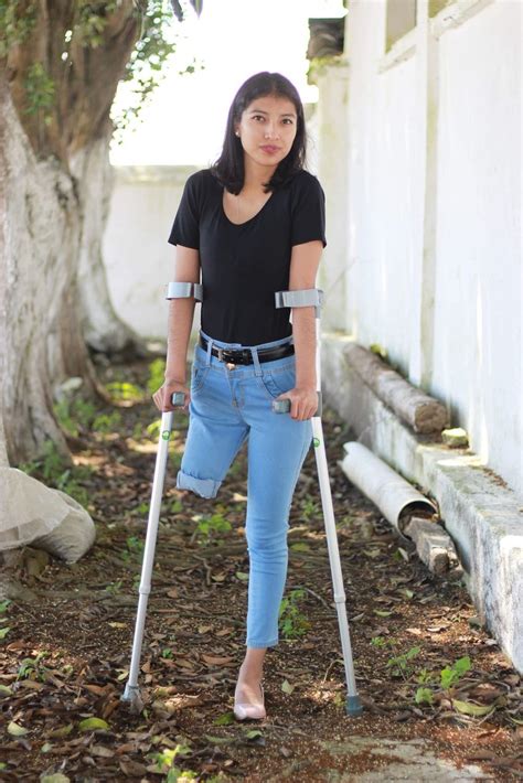 Amputee Legs Stumps And Prostheses