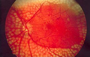 For advanced proliferative retinopathy, laser surgery is often helpful. Medical AI May Be Better at Spotting Eye Disease Than Real ...