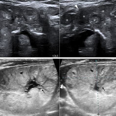 Pdf Ultrasonographic Features For Differentiating Follicular Thyroid