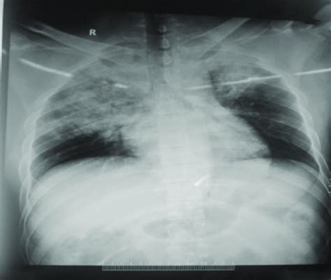 Chest X Ray Of A Patient At Presentation Patchy Areas Of Consolidation