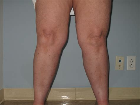 Learn If Fat Legs Are Considered Lipedema Lipedema Legs