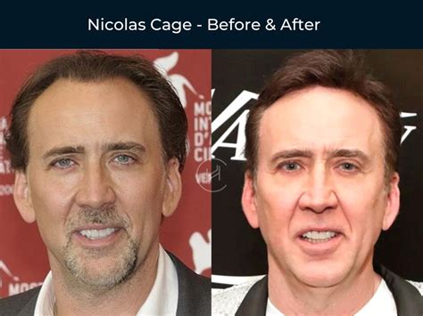 Celebrity Hair Transplant Before And After