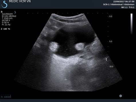 Can Bladder Cancer Be Seen On Ultrasound Updated