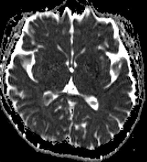 Choroid Plexus Xanthogranuloma Neuro Mr Case Studies Ctisus Ct Scanning