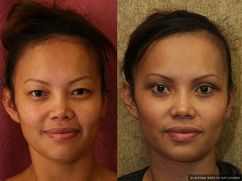 What is a botox brow lift? Patient #9891 Asian Eyelid Surgery (Blepharoplasty) Before ...