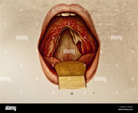 Soft Palate Mouth Hi Res Stock Photography And Images Alamy
