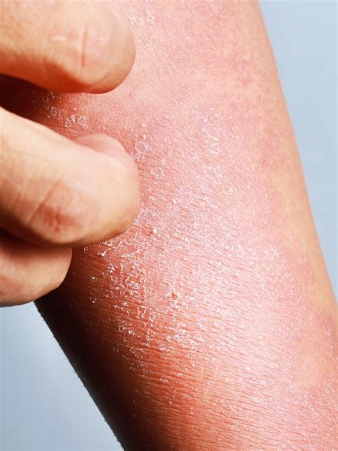 Eczema Vs Psoriasis Whats The Difference Cambridge Therapeutics