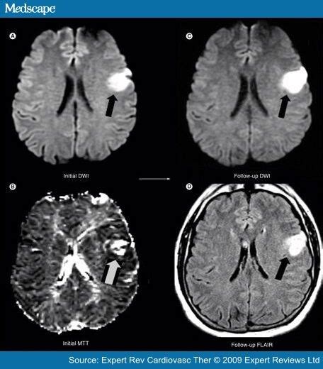 Neuroimaging Of Ischemic Stroke With Ct And Mri