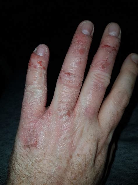 Eczema On Top Of Hands