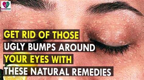 Get Rid Of Those Ugly Bumps Around Your Eyes With These Natural