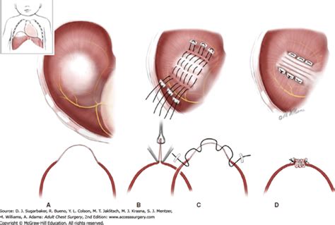 Plication Of The Diaphragm From Above Thoracic Key