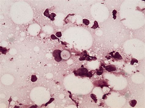Cytologic Diagnosis Of Lobular Carcinoma Of The Breast Menet 2008