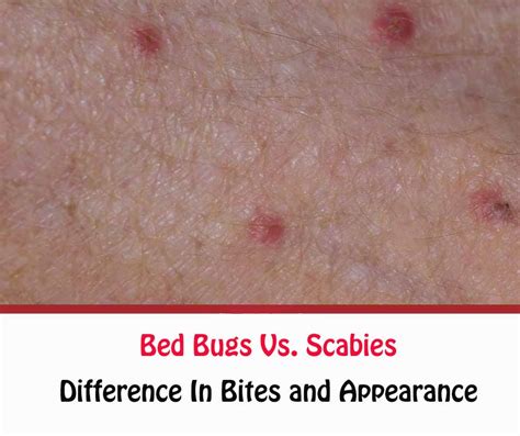 Bed Bugs Vs Scabies Difference Between Scabies And Bed Bugs