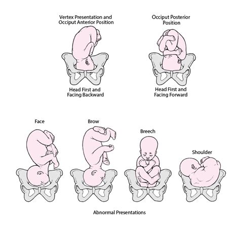 fetal presentation position and lie including breech presentation gynecology and
