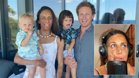 Turia Pitt Opens Up About Life Changing Surgery After Demoralising Process