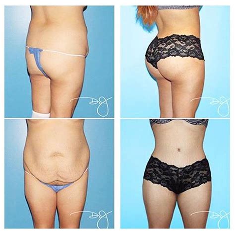 How to sleep after having a bbl procedure & tummy tuck by dr. Butt Lift Without Surgery - Pussy Photos
