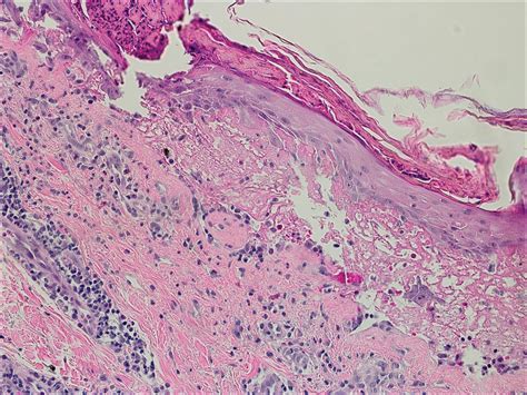 Bullous Pemphigoid Associated With A Lymphoepithelial Cyst Of The