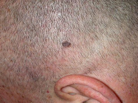 Skin Cancer On Scalp Prevention Tips For Bald Men — Scary Symptoms