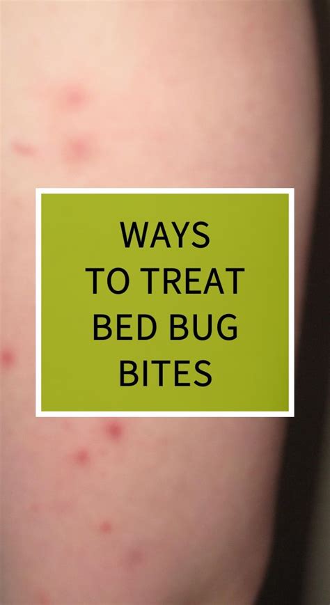 Ways To Treat Bed Bug Bites Bed Bug Bites Organic Health Herbal