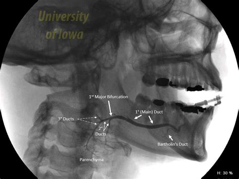 Anatomy Of Submandibular Gland And Duct Iowa Head And Neck Protocols