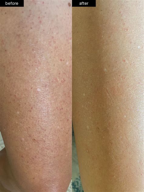 Body Smoothing System Slmd Skincare By Sandra Lee Md Dr Pimple