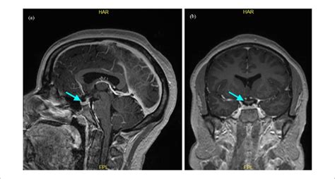 Brain Magnetic Resonance Imaging Mri With And Without Contrast Download Scientific Diagram