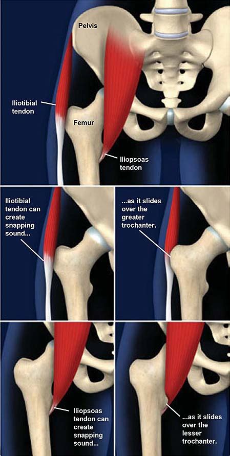 Snapping Hip Syndrome Central Coast Orthopedic Medical Group