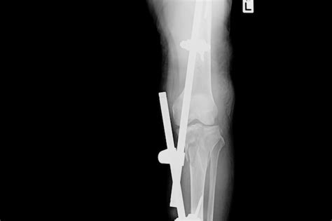 Premium Photo Show Fracture Tibia And Fibula X Ray Image Of Fracture