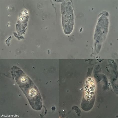 Hyaline Casts In Patient With Aki