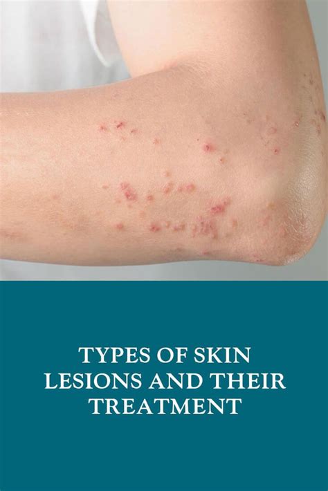 Learn vocabulary, terms and more with flashcards, games and other study tools. Types of Skin Lesions and Their Treatment | Dubai Cosmetic ...