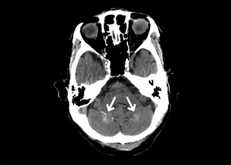 Calcifications Seen On A Normal Non Contrast Cranial Ct Hku E Learning Platform In Clinical