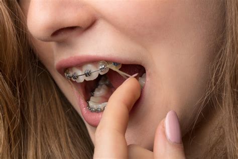 How Important Is It To Wear Your Orthodontic Rubber Bands Belmar