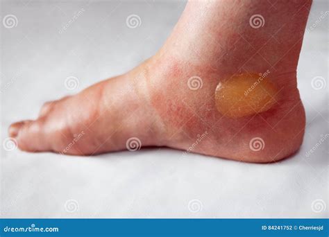 A Bare Leg With A Painful Heel Is Wound In Kind Women`s Feet Are