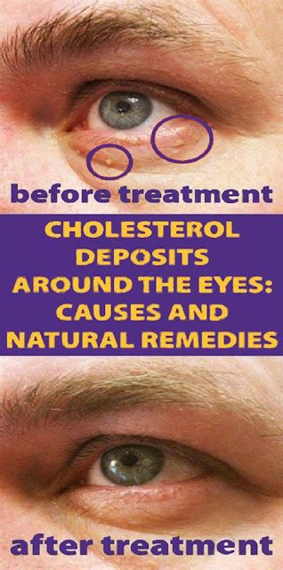 How To Remove The Cholesterol Deposits Around Your Eyes Wellness Magazine