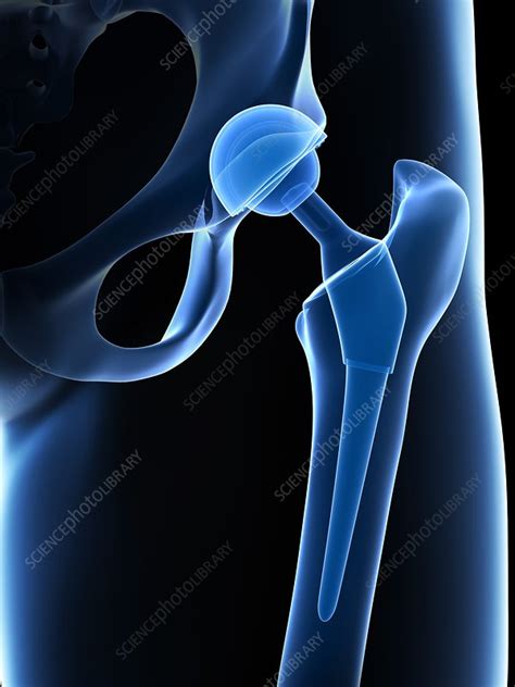 Human Hip Replacement Artwork Stock Image F009 6890 Science Photo Library