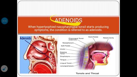 Adenoids Youtube