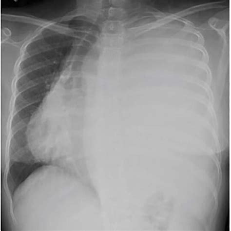 Frontal Chest Radiograph 2 Months After Resection With Near Complete