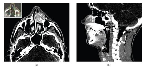 Ct Scan Showing A Contrast Enhanced Lesion With Central Sunburst
