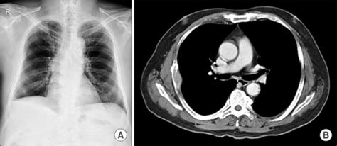 Figure 1solitary Plasmacytoma Of The Rib Open I