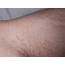 Is Your Scabies Worse After Treatment  HubPages