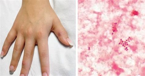 Woman Develops Gonorrhea Rash On Her Hands And All Over Her Skin