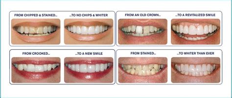 Click to find out everything you need to know about getting veneers in this article. Dental Veneers | Guide on Dental Veneer | Prices, Risks ...