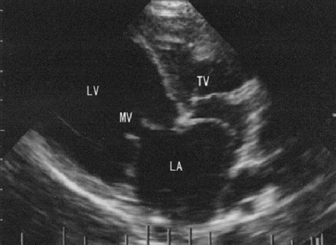 Right Parasternal Long Axis Two Dimensional Echocardiogram